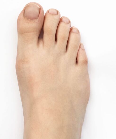 Meggyógyítottam a hüvelykujj valgusemet Hondro Sol Valgus spray-vel