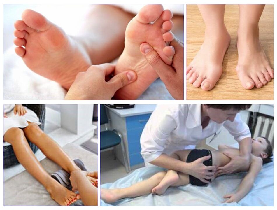 Valgus deformáció a gyermekek kezelésében