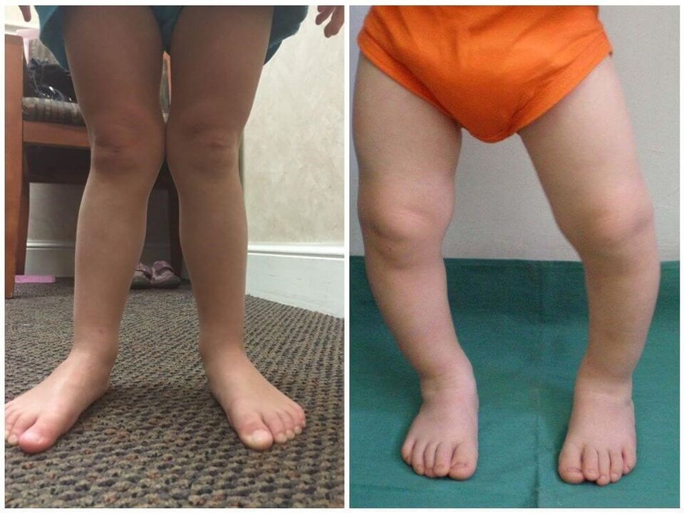Valgus deformáció a gyermekeknél