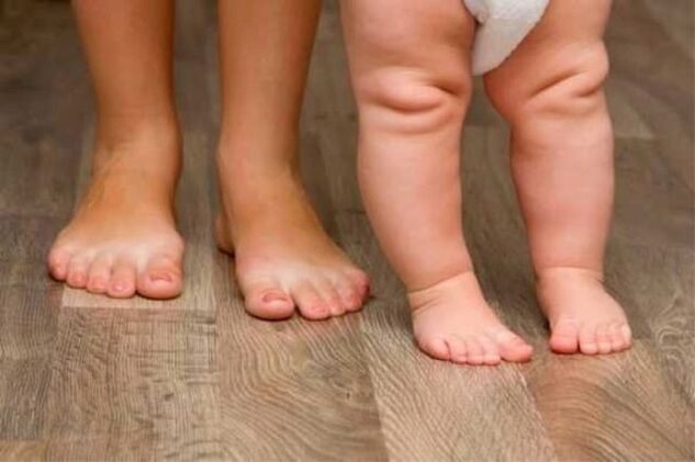Valgus deformáció
