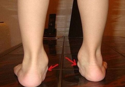 A lábak valgus deformációja gyermekeknél