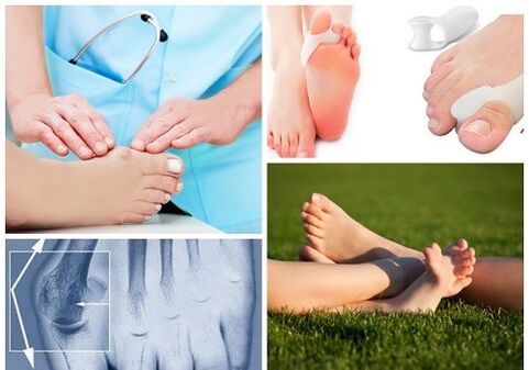 A valgus deformáció kezelése