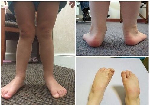 Valgus deformáció gyermekeknél