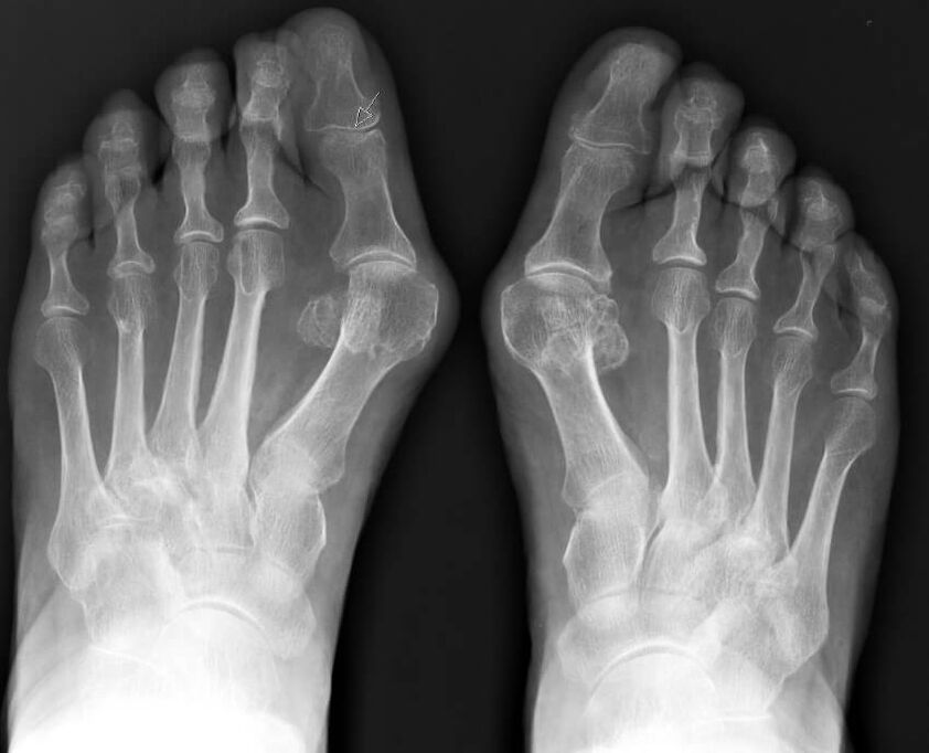 Röntgen hallux valgus