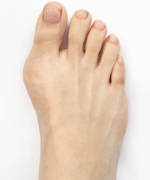 hallux valgus Hondro Sol Valgus spray használata előtt